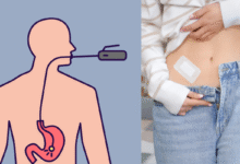 Gastroshiza